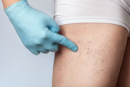 Spider Veins - What are they and how do I get them treated? - Vein Doctors  Group