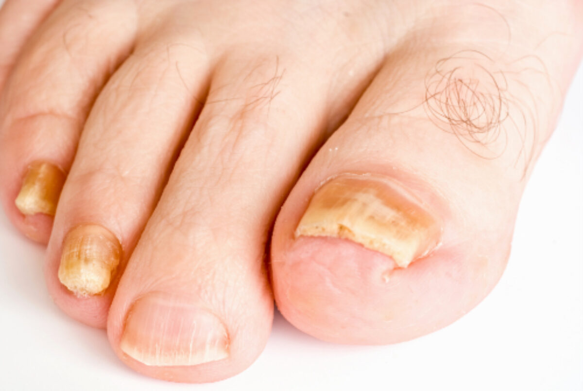 Everything you need to know about fungal nail infections! - ProMed Clinic