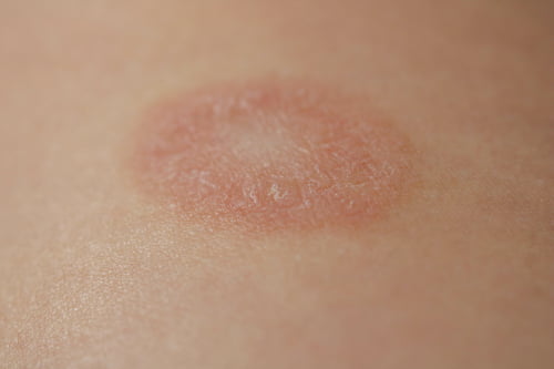 Pityriasis Rosea Condition, Treatments and Pictures for Teens