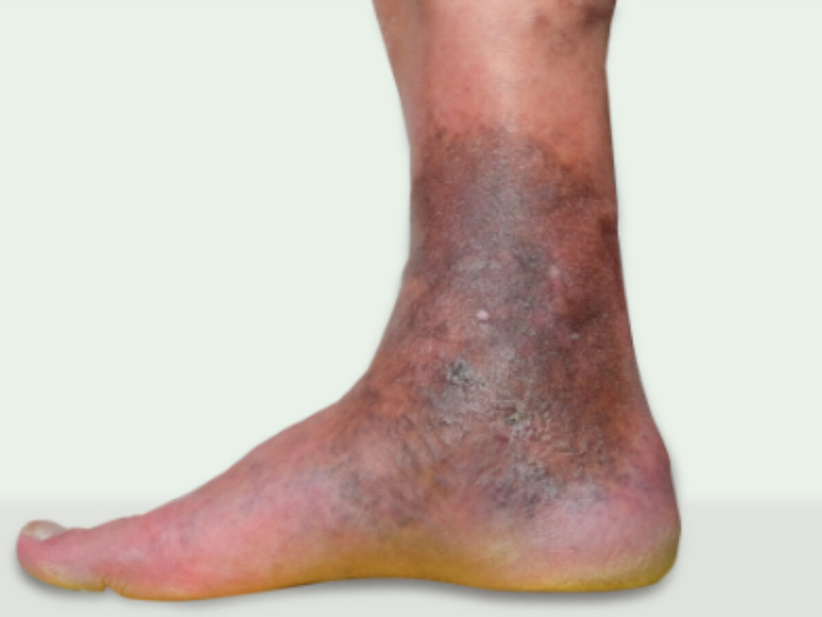 Venous Stasis Dermatitis Description