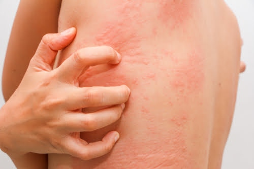 Urticaria Hives Dermatology Group Of The Carolinas