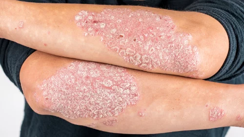 psoriasis-1