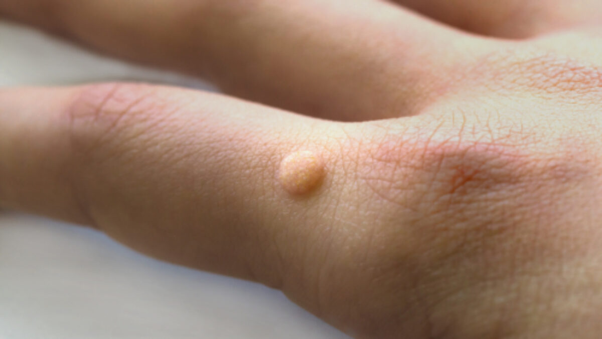 Warts