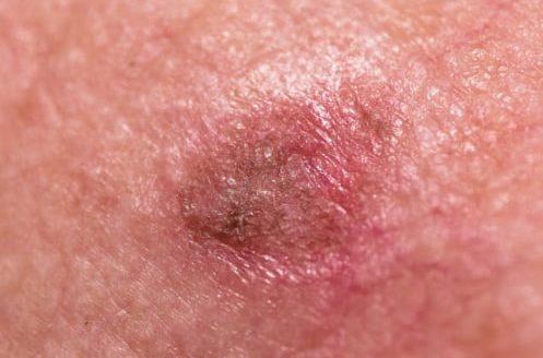 actinic-keratosis-on-cheek