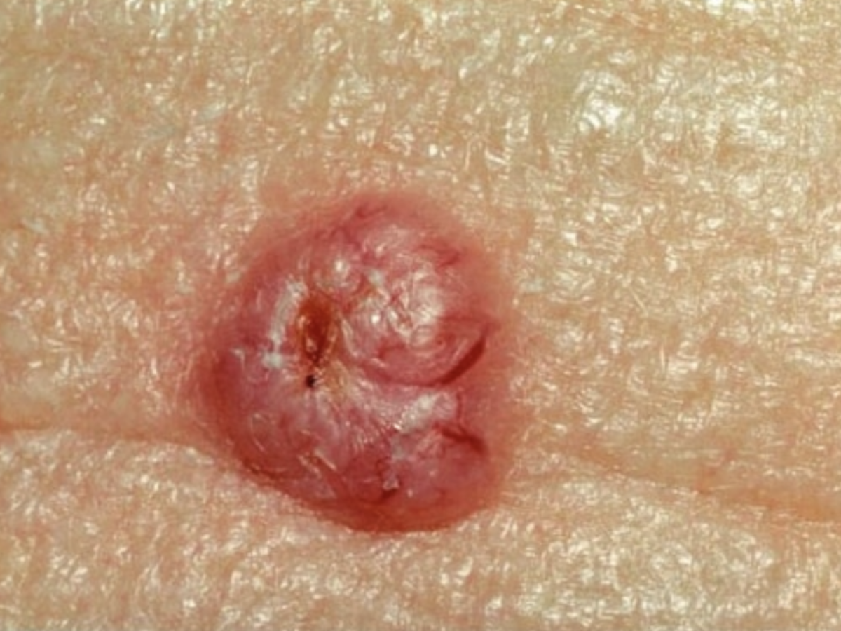 Basal Cell Carcinoma