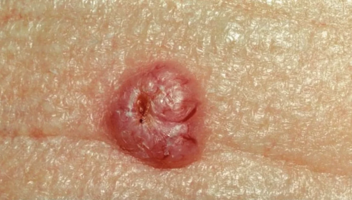 basal-cell-carcinoma-1