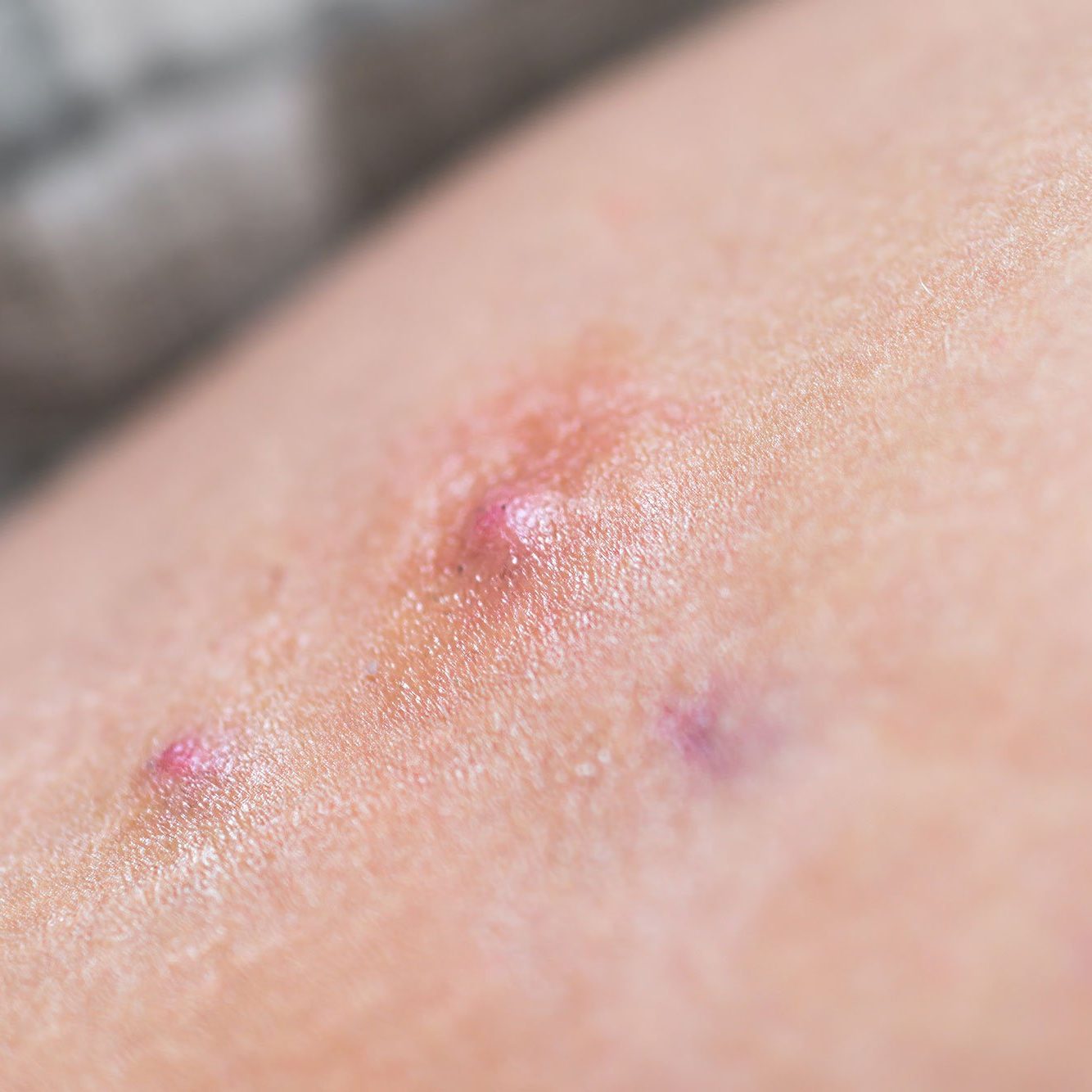 Mild Hidradenitis Suppurativa Buttocks