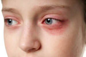 Eyelid Dermatitis | Dermatology Group Of The Carolinas