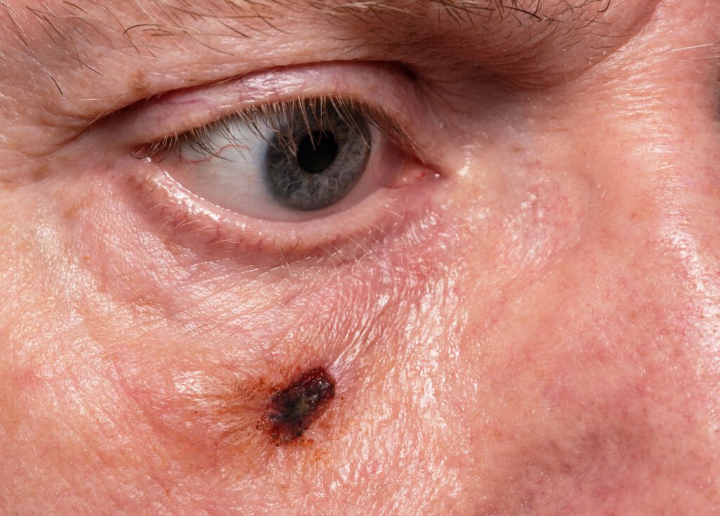 MohsSurgery Mohs Surgery