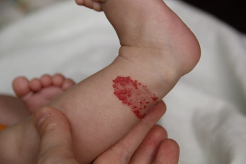 Hemangiomas | Dermatology Group of the Carolinas