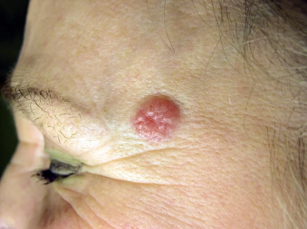 Basal Cell Carcinoma | Dermatology Group of the Carolinas