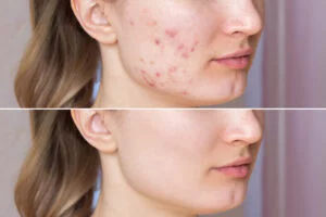 Adult Acne | Dermatology Group of the Carolinas