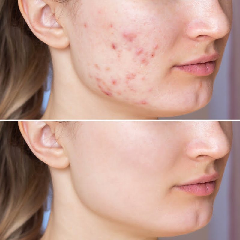 Adult Acne Treatment Prescription